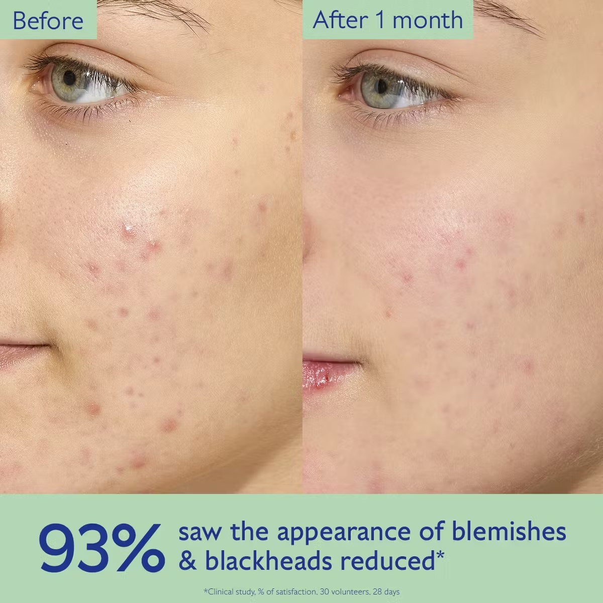 Oil-Control Moisturizer for Acne Prone Skin